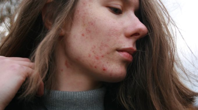 The Ultimate Acne Guide: Causes, Treatment, and How to Prevent Future Breakouts